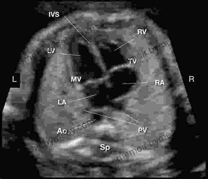 Ultrasound Image Of A Fetal Heart A Practical Guide To Fetal Echocardiography: Normal And Abnormal Hearts